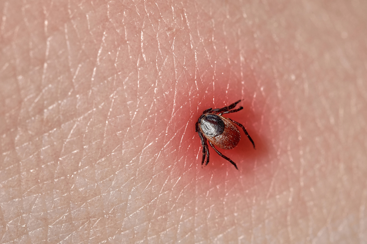 Sucking Tick Macro Photo on Human Skin. Ixodes Ricinus. Bloated Parasite Bitten into Pink Irritated Epidermis. Small Red Drops. Dangerous Insect Mite. Encephalitis, Lyme Disease Infection.